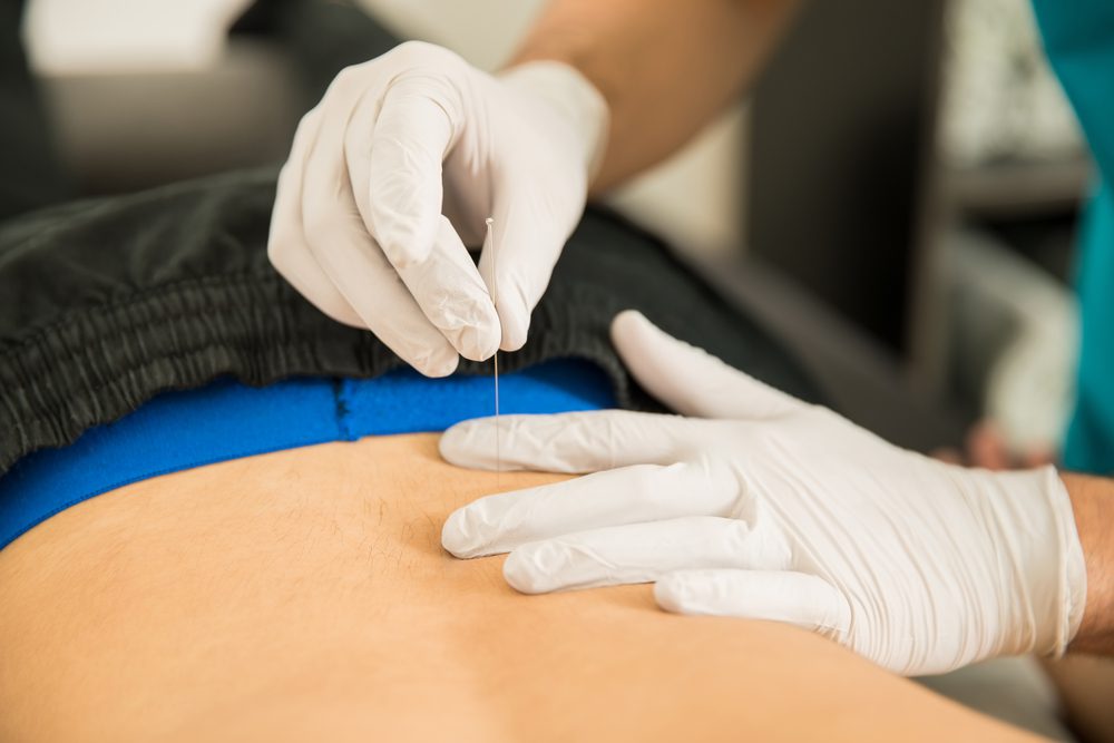 Physiotherapist Doing Dry Puncture On Back Of Male Patient image of male physiotherapist doing dry puncture on the back of patient in clinic